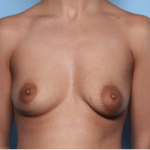 Breast Lift with Implant Before & After Patient #34302